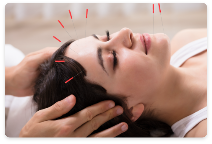 acupuncture image